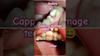 Capping on Damaged Teeth 🦷😏bdshorts dental teethwhitening teeth smile [upl. by Haimirej342]