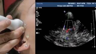 How To Transcranial Doppler [upl. by Orest]