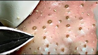 Best Satisfying Nose Plucking Blackheads Whiteheads Removal  Acne Treatment 19 [upl. by Martina319]