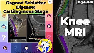 Fig 4B16 Osgood Schlatter Disease Cartilaginous Stage [upl. by Rowell]