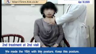 Torticollis Cervical Dystonia [upl. by Einniw]