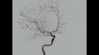 Arteriografia Cerebral Normal [upl. by Mayman]