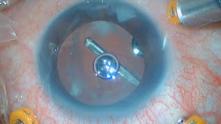 Vitrectomy to Remove Retained Lens Fragments  Posterior Capsular Rupture  Cataract Surgery [upl. by Nitsug79]