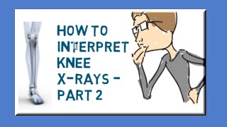 How to interpret knee Xrays  Part 2  lateral view [upl. by Shiverick]