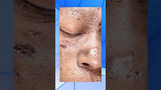 Black head acne [upl. by Mather]