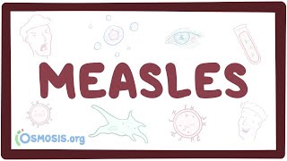 Measles  causes symptoms diagnosis treatment pathology [upl. by Haberman]