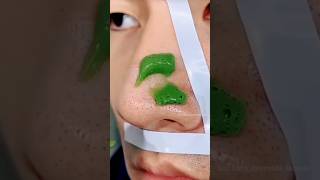 ✅Nose Blackheads Whiteheads Removing At Home 💯 shortsviraltrendingblackheads [upl. by Eliot]