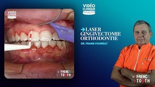 Laser gingivectomie orthodontie  Dr Pourrat [upl. by Elamaj126]