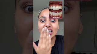 Hismile teeth whitening tooth paste ❤️ affordablestore teethwhitening [upl. by Ardnaxela966]