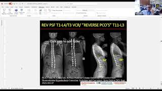 What Is the Target for Optimal Sagittal Alignment and How Do We Achieve It  Lawrence G Lenke MD [upl. by Upton539]