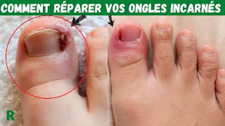 Comment réparer les Ongles incarnés rapidement et facilement [upl. by Umeko]