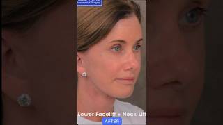 Lower Facelift Surgery Before and After  Facelift Surgery  Mini Facelift Before After  Neck Lift [upl. by Elva163]