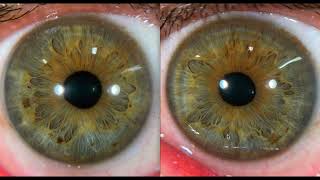 Iridology A Quick Reading Example  Digestive amp Glandular Signs [upl. by Kris]