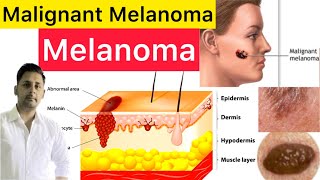 Malignant Melanoma Cause Risk Factors Types Diagnosis amp Treatment  What Is Malignant Melanoma [upl. by Htomit]