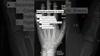 Delayed puberty in boys [upl. by Bartholomeo773]