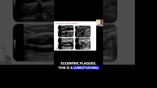 Carotid Plaque Geometry foryou science education vascularultrasound [upl. by Kire359]