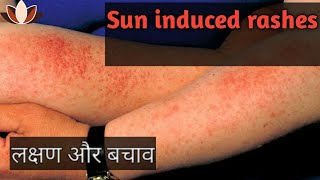 sun allergies  can you be allergic to sunlight  heres what you need to know  PMLEhow to prevent [upl. by Hak173]