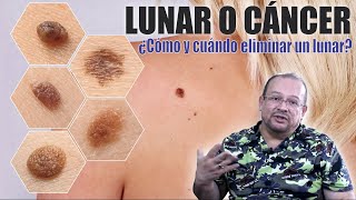 LUNARES Cuando y cómo retirarlos 🚫 Cuidado con los MELANOMAS Cáncer ❤️ DR ALBERTO CALVO QUIROZ [upl. by Htiek150]