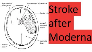 Stroke and death after Moderna [upl. by Caffrey507]