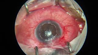 Anterior lamellar keratoplasty with corneal tattoo [upl. by Nigle]