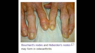 Osteoarthritis  Osteophytes on PIP Bouchards Nodes DIP Heberdens Nodes [upl. by Oirtemed]