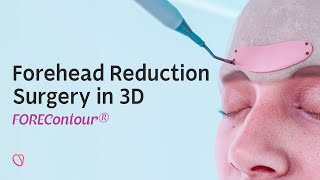 FOREContour® — Forehead Reduction Surgery in 3D [upl. by Eem540]