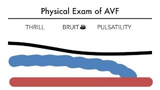 Hemodialysis Access 101 03  Physical Exam of AVF [upl. by Atimed]