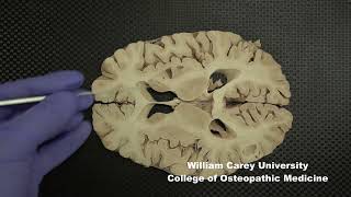 Horizontal slices of human forebrain neuroanatomy forebrain internal capsule caudate nucleus [upl. by Ynabe]