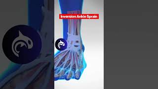 See the difference between both Eversion and Inversion Ankle Sprains in 3D Animation [upl. by Sumaes]