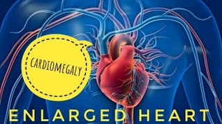 Enlarged Heart or Cardiomegaly  Causes Prevention amp Treatment  About Health [upl. by Barnabas]