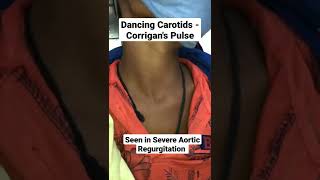 Dancing Carotids  Corrigans Pulse in severe Aortic Regurgitation mbbs medicine neet usmle [upl. by Bussey363]