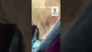 Skin lesion removal [upl. by Maiocco224]