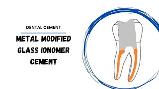 Metal Reinforced Glass Ionomer cement  Dental cermets [upl. by Anilam]