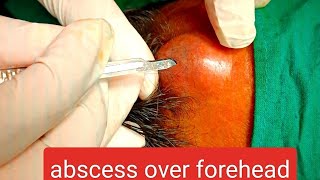 abscess over forehead  infected cyst over forehead  incision n drainage youtube dr doctor [upl. by Itin]