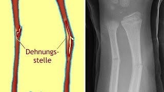 Grünholzfraktur Ursachen Diagnose und Behandlung [upl. by Fern]