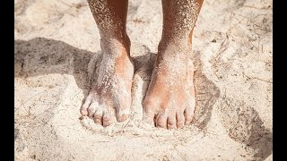 SAND FLEA BITES HOW TO DEAL WITH THE BITES [upl. by Abijah]