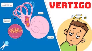 Vertigo from BPPV  Causes Symptoms and Treatment [upl. by Ahseeyt599]