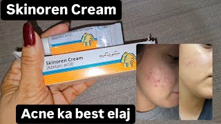 Skinoren cream  best way to get rid of acne  cehre se acne gayab [upl. by Ahasuerus]