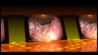 Gastroscopy of Stomach Cancer [upl. by Fenelia]