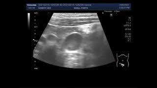 Mesenteric lymphadenitis [upl. by Gan]