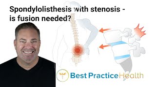 Is fusion necessary for the treatment of spondylolisthesis with stenosis  Best Practice LIVE [upl. by Eicrad]