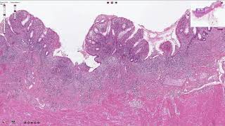 Ulcerative Colitis  Histopathology [upl. by Ordnaxela]