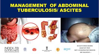 Management of Abdominal TB  Tubercular AscitesIntestinal TB [upl. by Allred]