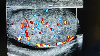 acute epididymoorchitis Tauhid ultrasonography Cumilla [upl. by Fleisig]