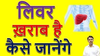 Liver Kharab Hone Ke Lakshan I Liver Damage Hone Ke Lakshan l Jondila Syrup Homeopathic [upl. by Nevah]