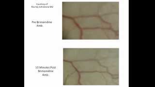 Video Brimonidine Causes Rapid Increase in Pulsatile Aqueous Outflow [upl. by Wendelina345]