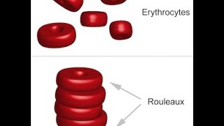 Multiple Myeloma [upl. by Sibbie]