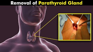 How Parathyroid Gland Surgery Is Performed UrduHindi [upl. by Alian]