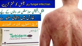 Terbiderm Tablets Uses In Urdu  Terbinafine  Anti Fungal Cream  Skin Infection  Terbiderm [upl. by Gayla]