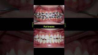 Braces Fix Misaligned Jaw braces orthodontist dentist bracesoff [upl. by Anikat232]